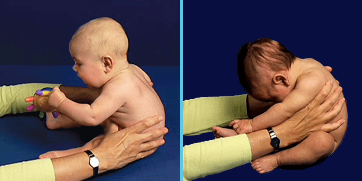 Recognizing Early Motor Delays at 2, 4, 6 Months of Age and Importance of Tummy Time