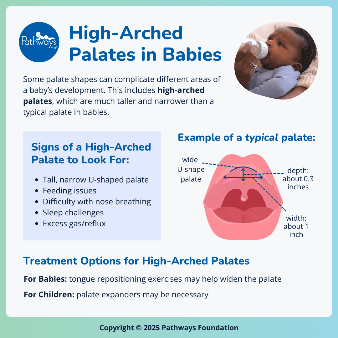 Infographic defining what a high-arched palate is and signs to look for, with a graphic of a typical palate for comparison and an image of a baby boy drinking from a bottle.
