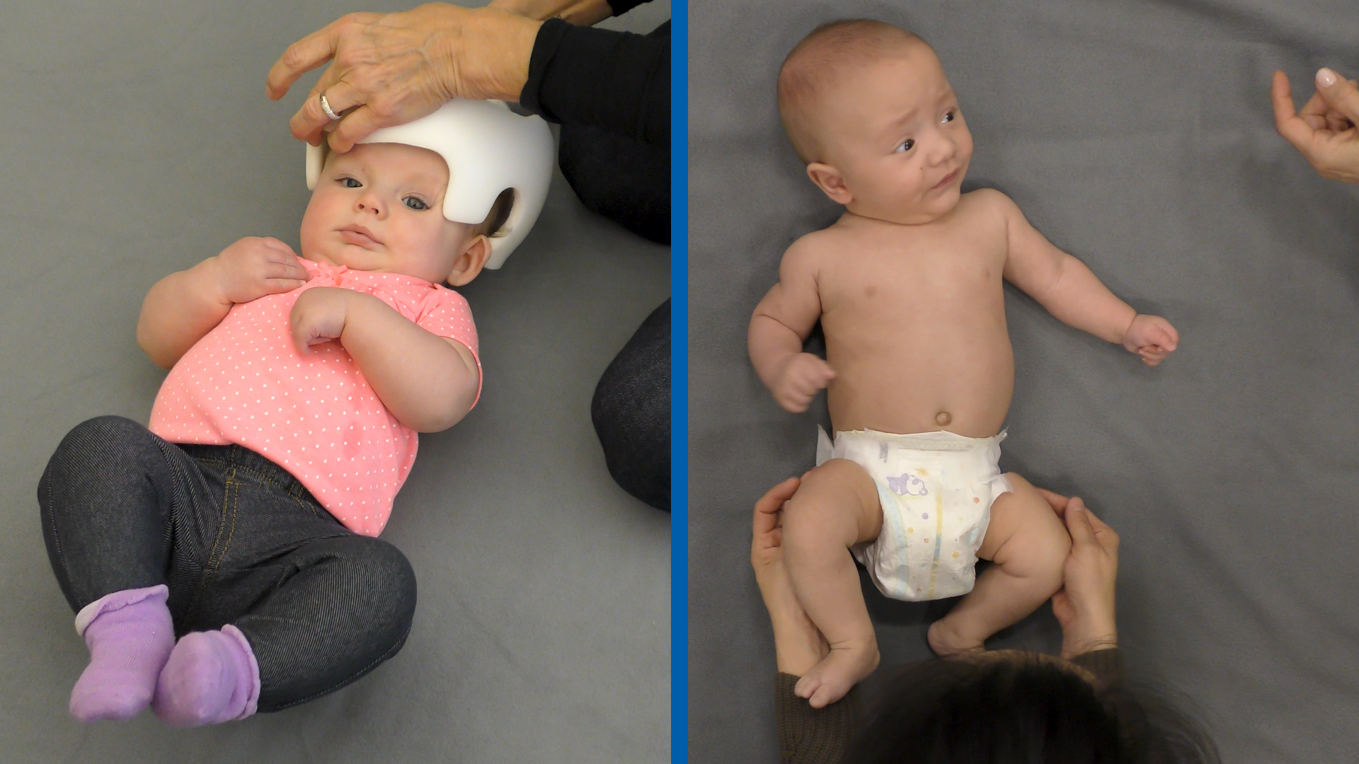 Two side-by-side images: The left shows a baby girl with positional plagiocephaly wearing a helmet. The right shows a boy with positional torticollis tilting his head to one shoulder.
