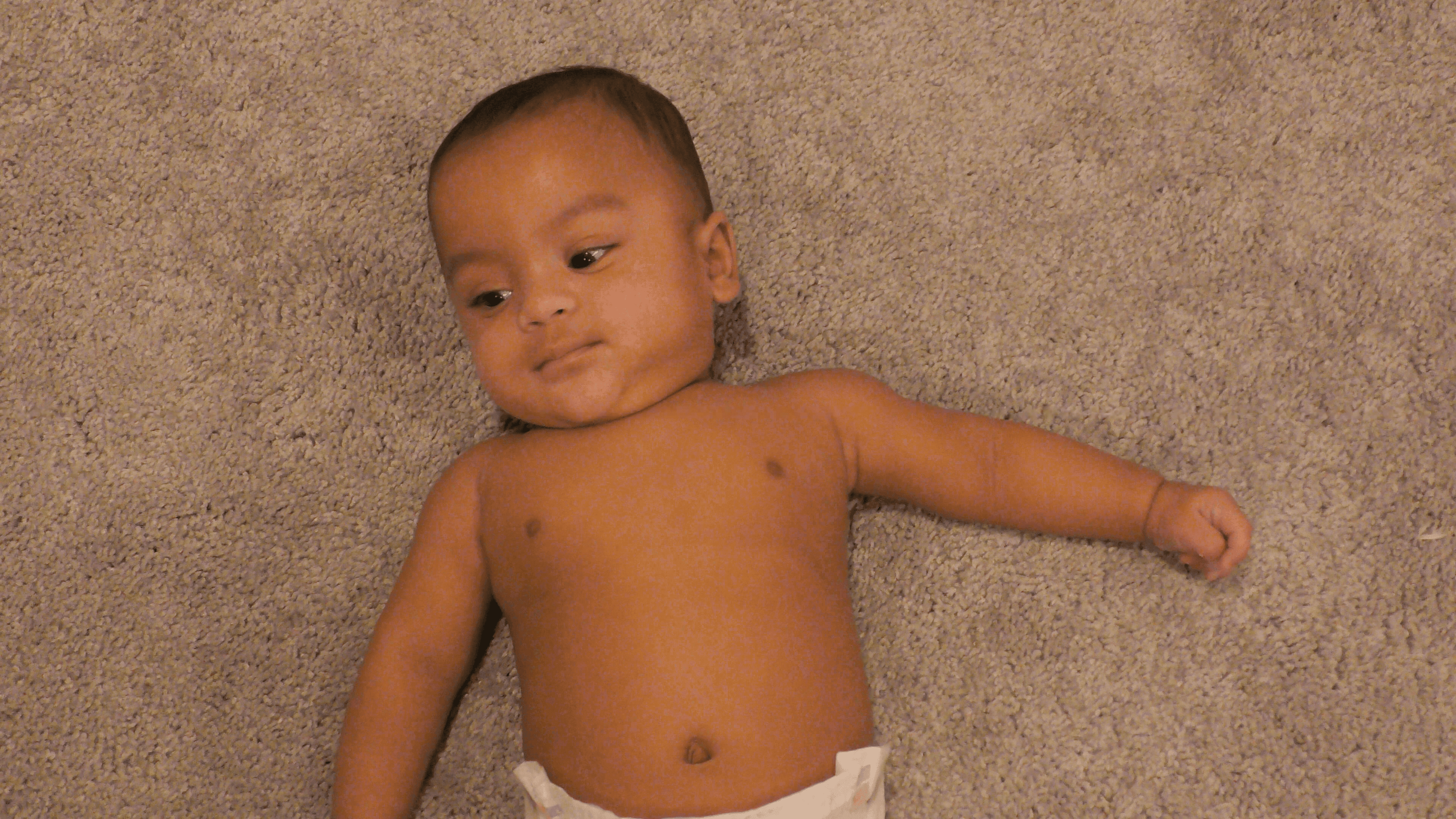 Baby boy with positional torticollis tilts his head to one side while lying on his back.
